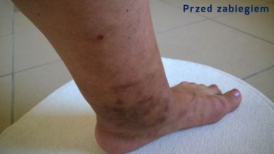 Before laser therapy